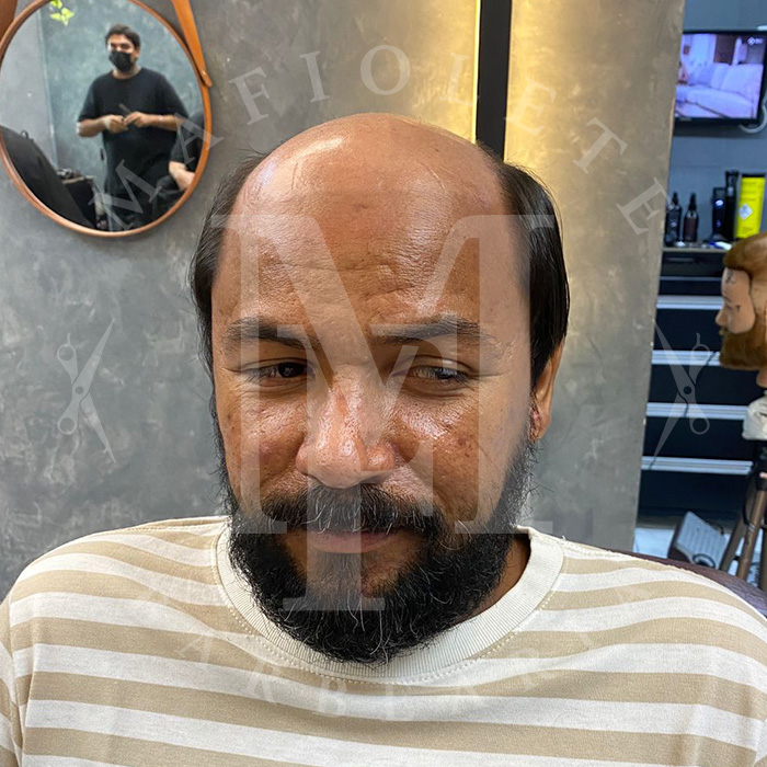 20250508-protese-antes